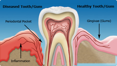 Non-Surgical And Surgical Periodontal Treatment