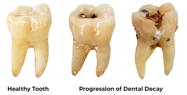Dental Decay